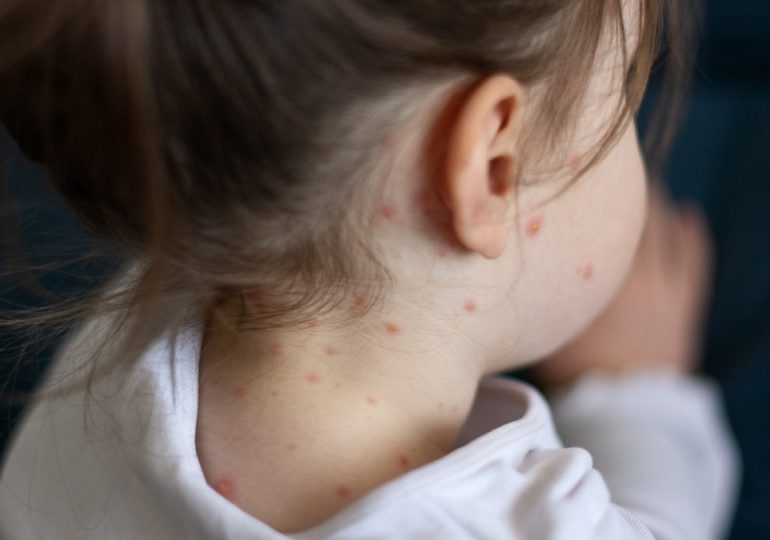 Measles cases continue to spread in multiple states following child’s death