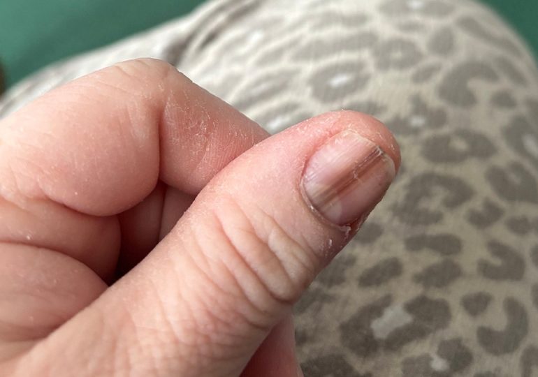 Mom credits TikTok video for life-saving cancer diagnosis after strange nail marking