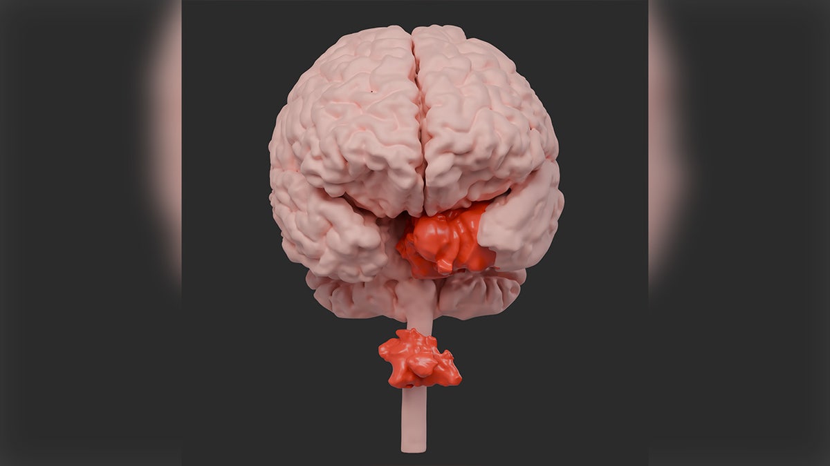 Illustration of patient's two spinal tumors
