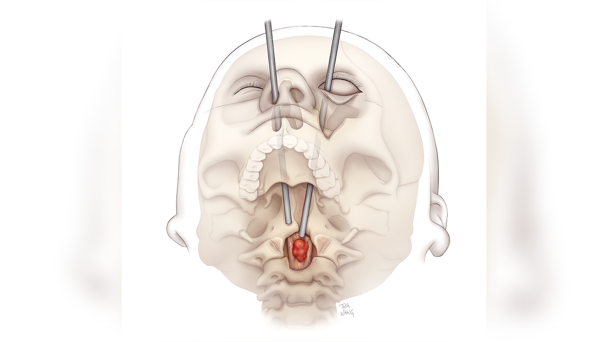 Illustration of transorbital path to tumors