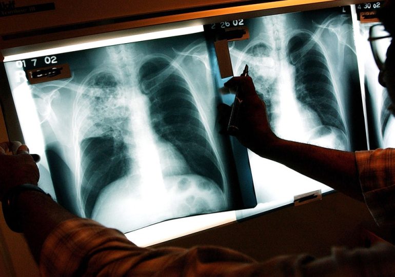 Three active tuberculosis cases reported in Maine as deadly disease continues to tick up across country