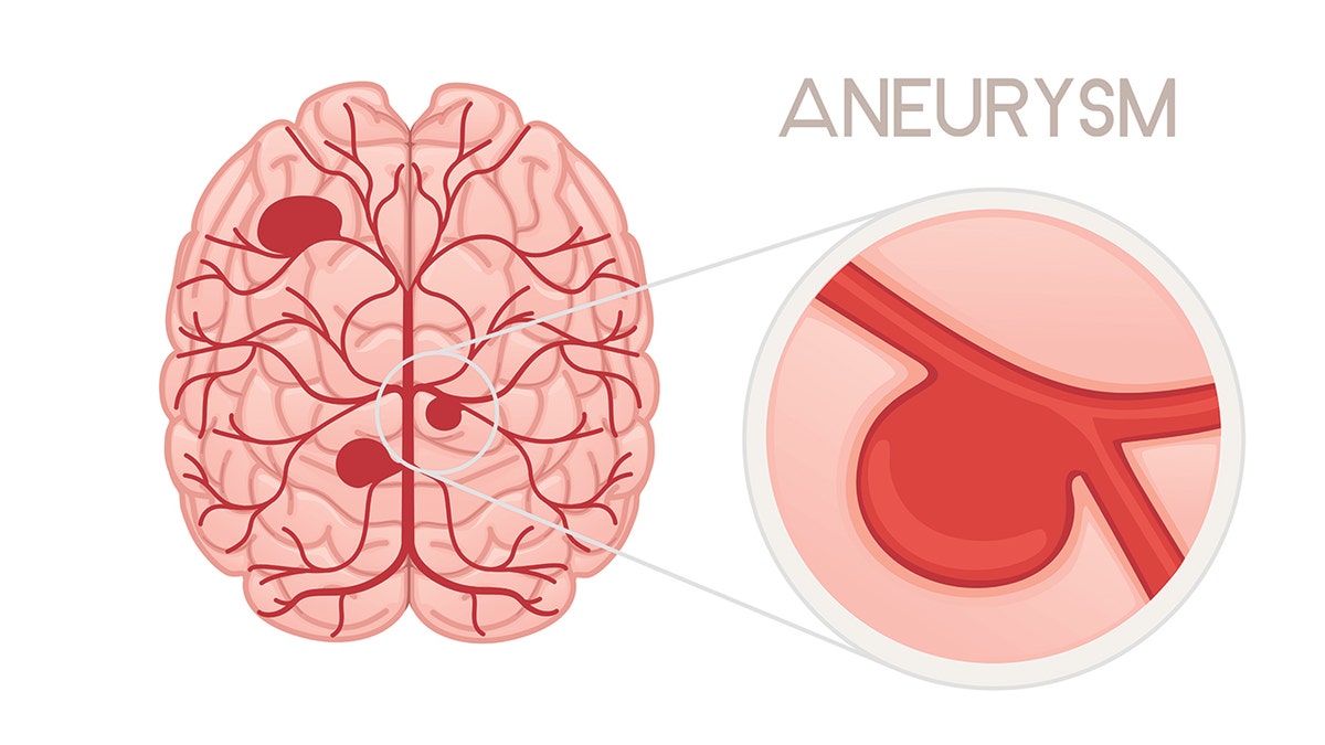graphic of a brain aneurysm