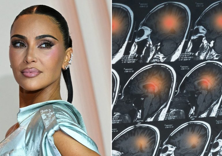 Kim Kardashian’s brain aneurysm scare: Doctors reveal warning signs to never ignore