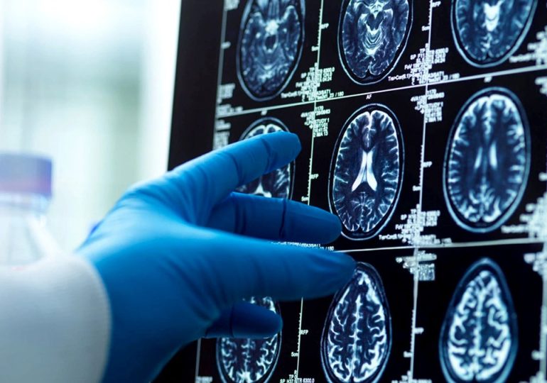 Men's brains shrink faster than women's; researchers explore Alzheimer's connection