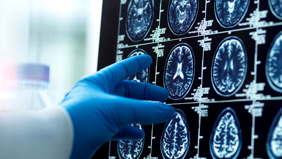 A doctor's hand in a surgical glove pointing at a brain scan image on a computer screen