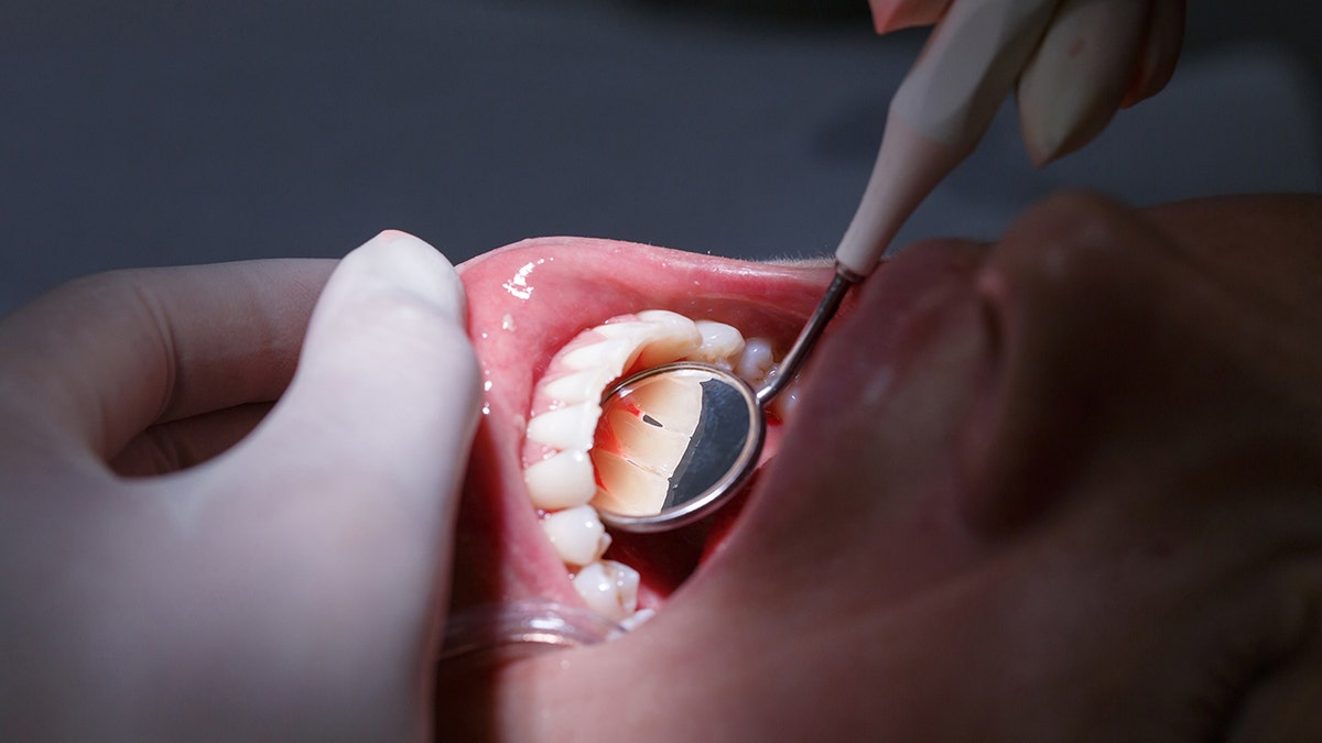 Close-up showing patient's moth at dentists office, getting her white teeth examined with hand-held mirror for tartar and plaque, dentist's gloved hands seen working.