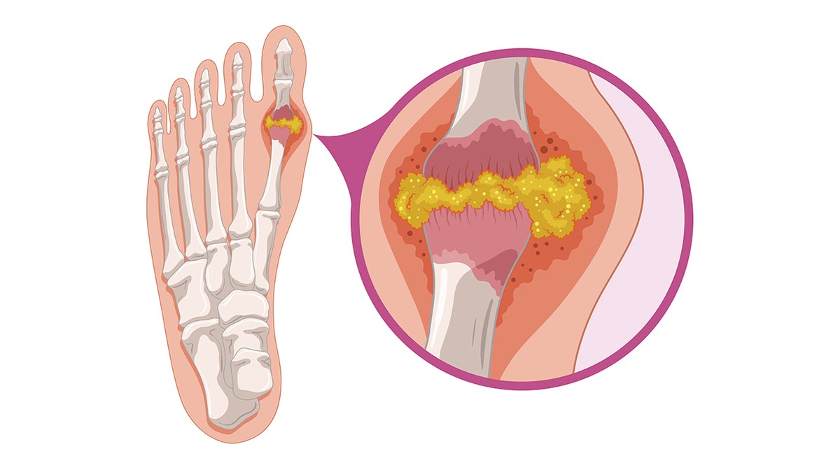 diagram of gout and uric acid buildup in the big toe