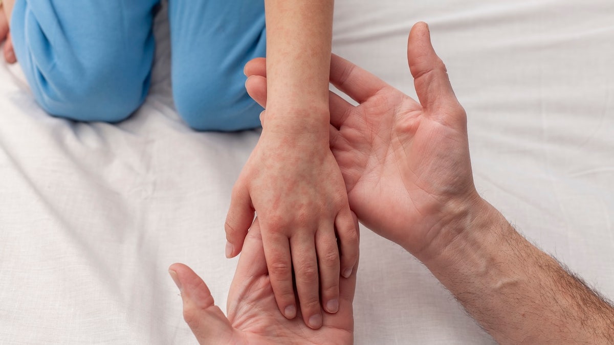 Child with measles rash