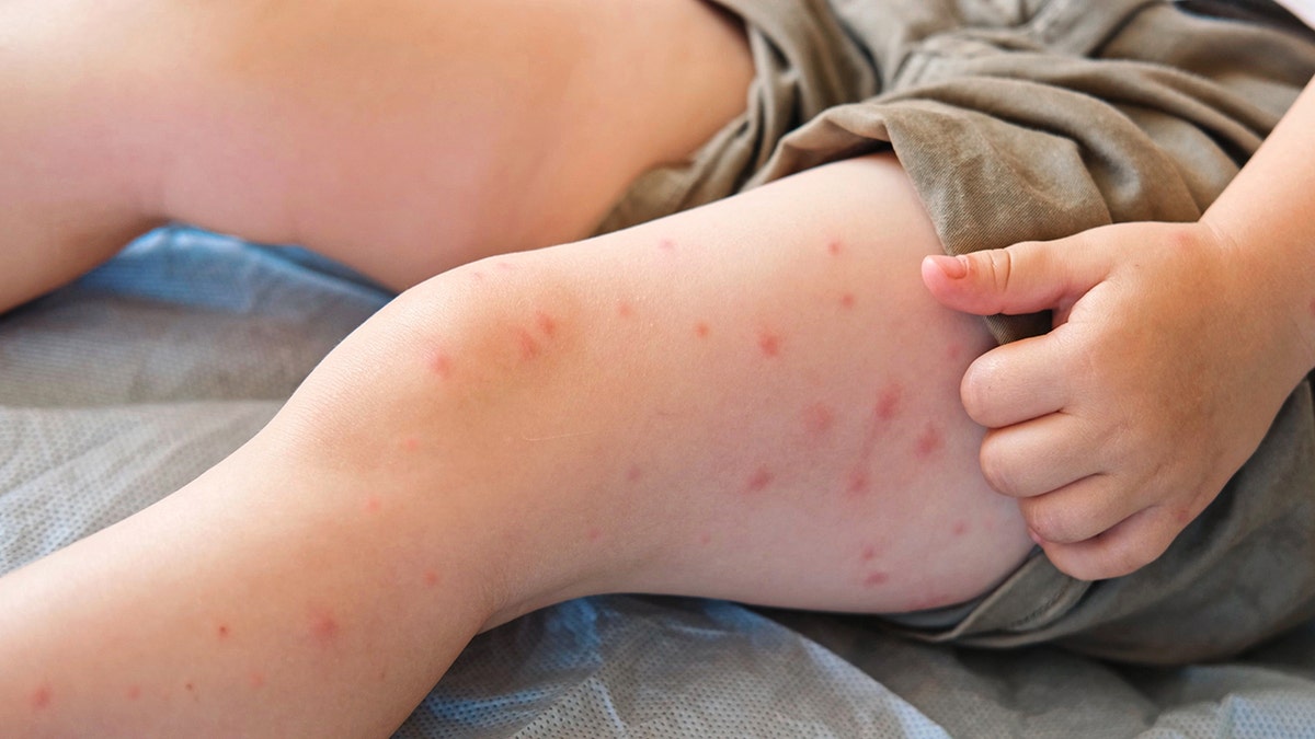 Child with measles bumps on leg.
